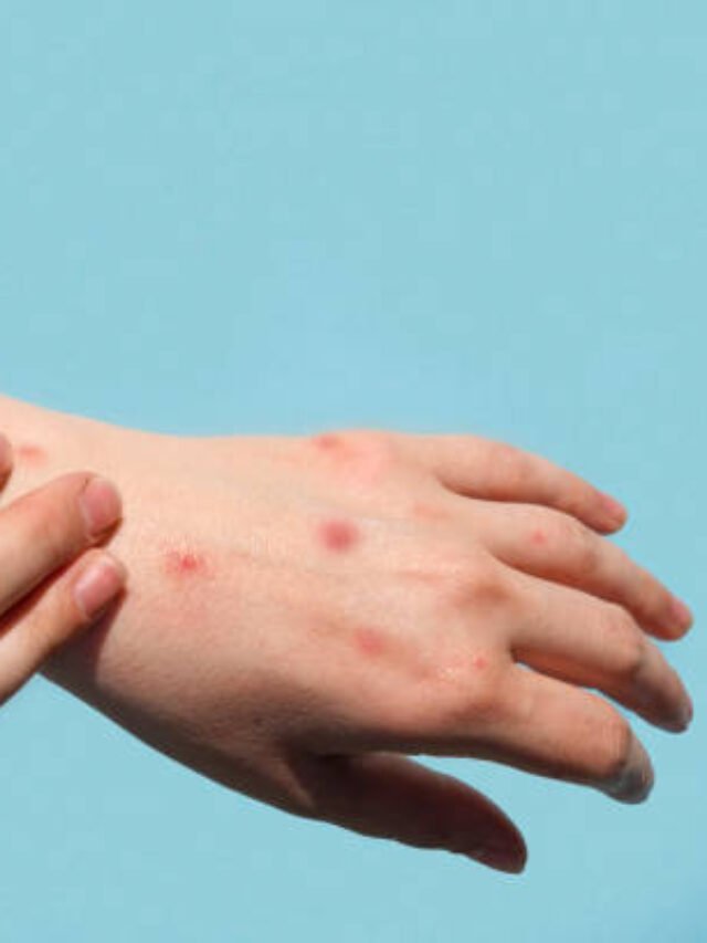 Alaska Pox Virus Caused Death of a Person, Health Alert